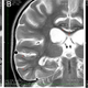 MRI 3, 31 and 162 days after drowning (Image: Paul Harch)